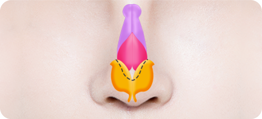 Partial of the cartilage is removed surgery illustration