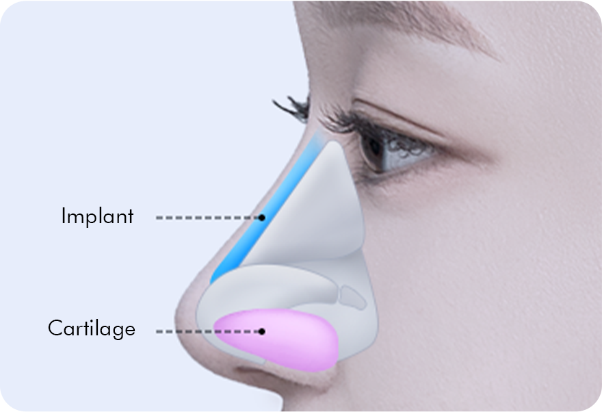 02. Silicone, autologous cartilage, etc. are inserted surgery illustration
