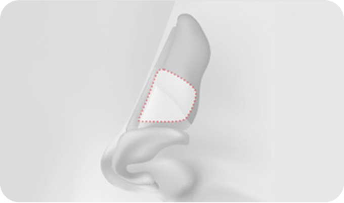 01. Septal Cartilage surgery illustration