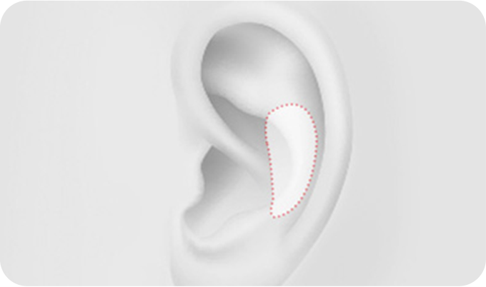 04. Ear Cartilage surgery illustration