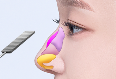 Prominent hump nose surgery — step 1