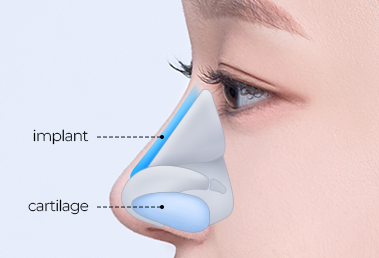 Low hump nose surgery — step 2