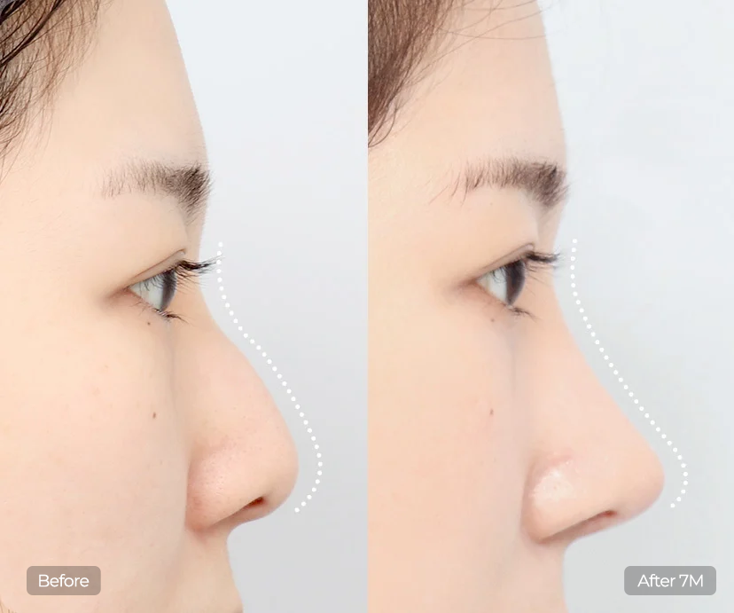 Hump Nose Rhinoplasty
