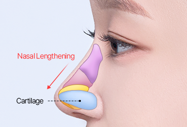 Short nose surgery — after: cartilage insertion and length extension