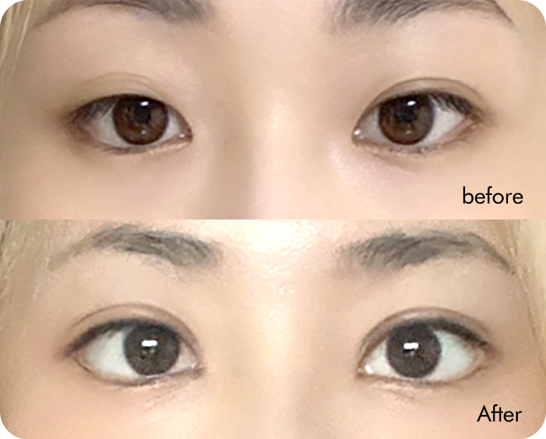 Semi-fancy translucent adhesion swelling comparison case 2