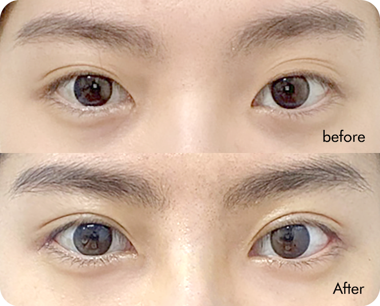 Semi-fancy translucent adhesion swelling comparison case 3