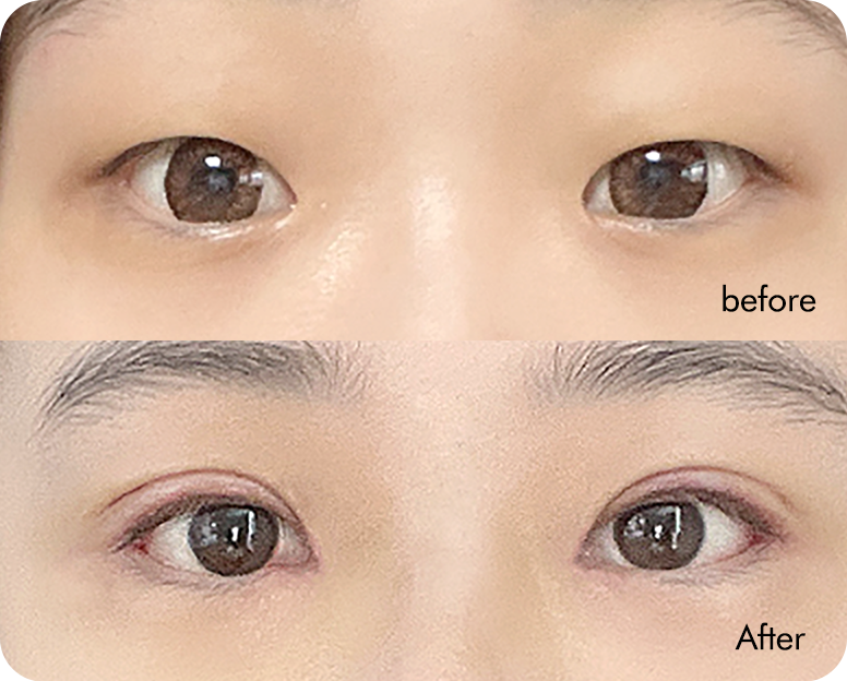 Semi-fancy translucent adhesion swelling comparison case 4