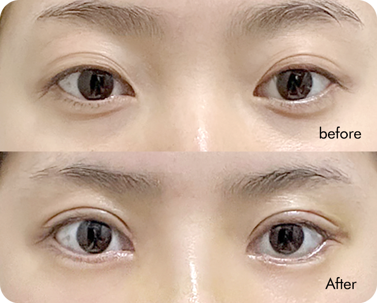 Semi-fancy translucent adhesion swelling comparison case 5