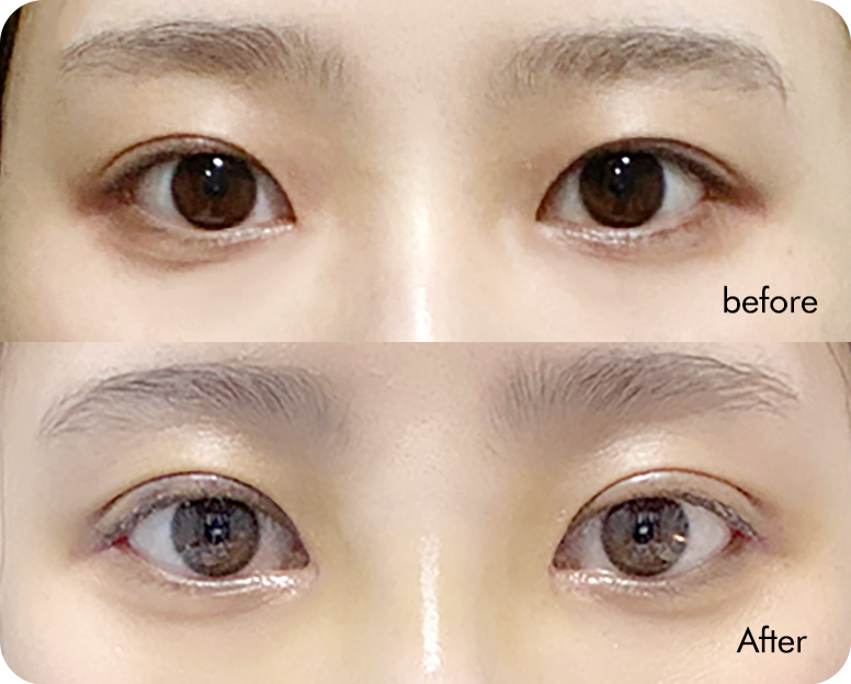 Semi-fancy translucent adhesion swelling comparison case 6