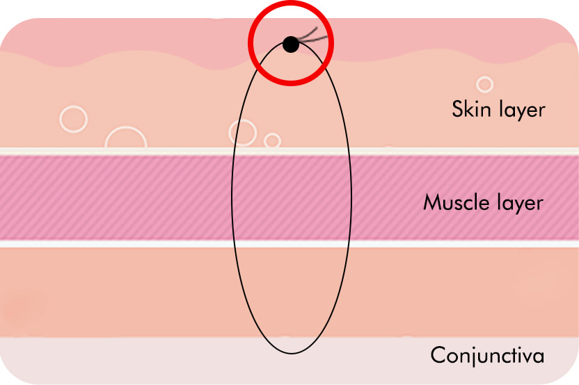 Translucent adhesion knot position method: Buried near the skin