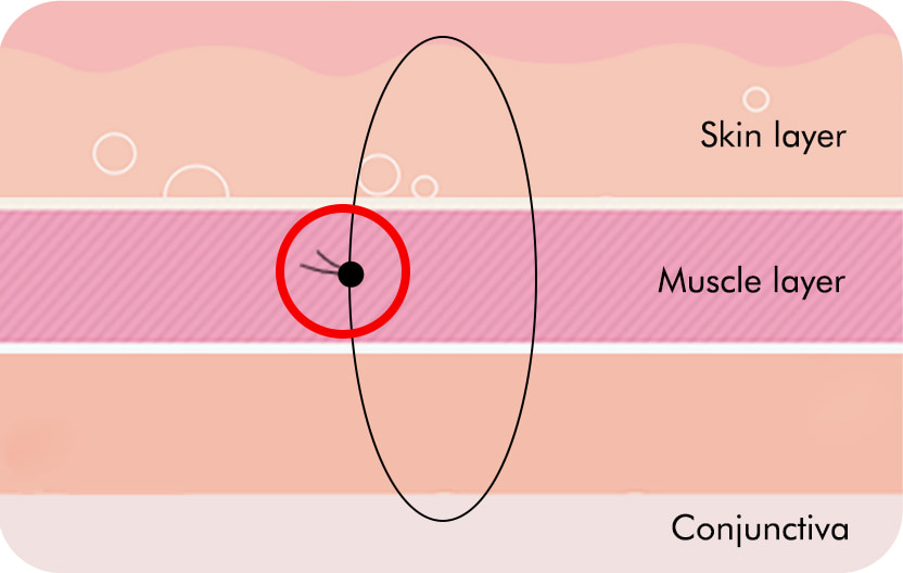 Translucent adhesion knot position method: Burial within the muscle