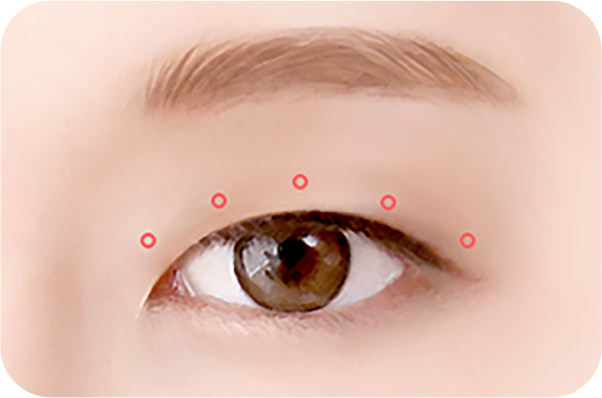 Semi-fancy translucent adhesion surgery method 01: Designed with a customized line tailored to each individual.