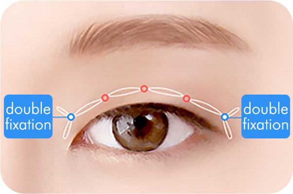 Semi-fancy translucent adhesion surgery method 02: Connected with multiple knots to prevent loosening of the skin and the muscle levator palpebrae superioris.