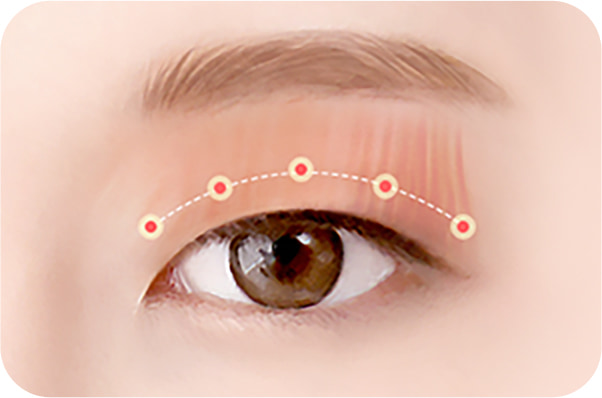Semi-fancy translucent adhesion surgery method 04: Creating semi- fancy double eyelids that remain inconspicuous even when eyes are closed.