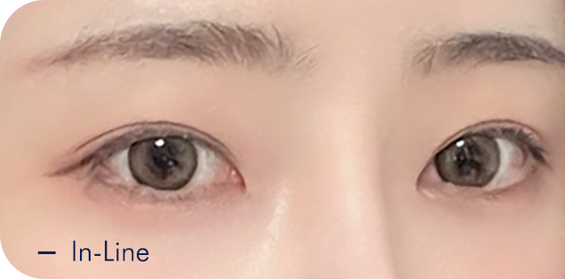 Translucent adhesion eyelid fold type 1