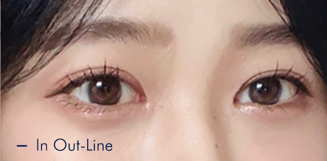 Translucent adhesion eyelid fold type 2