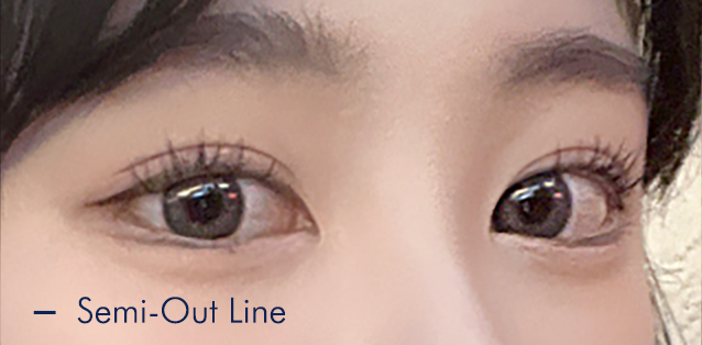 Translucent adhesion eyelid fold type 3