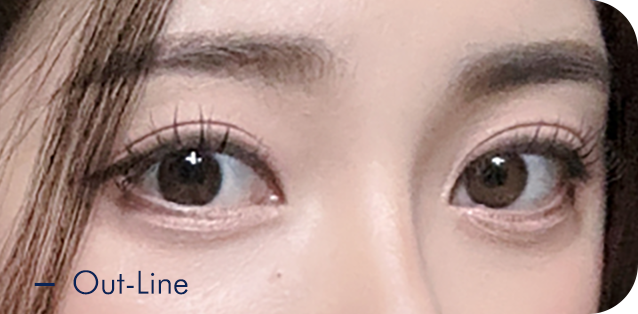 Translucent adhesion eyelid fold type 4