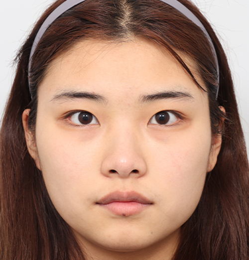 Before surgery surgery illustration