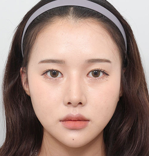 4 month after surgery surgery illustration