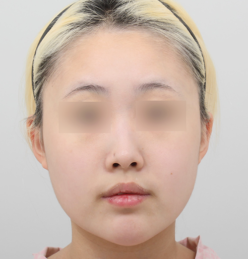 Before surgery surgery illustration