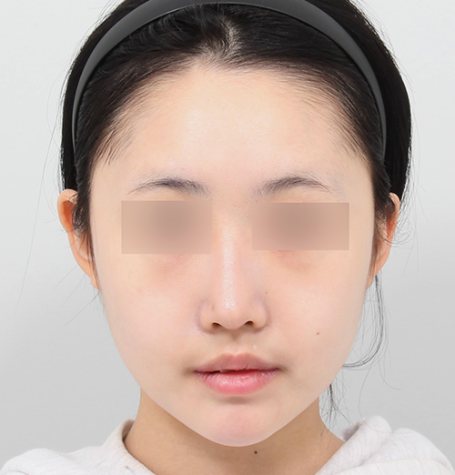 4 month after surgery surgery illustration