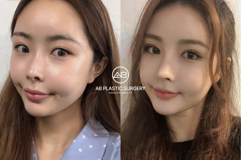Plastic Surgery in Korea 2024: A Step-by-Step Guide