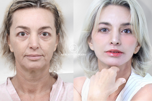 Plastic Surgery in Korea for Foreigners: Essential FAQs (2026) | AB Plastic Surgery
