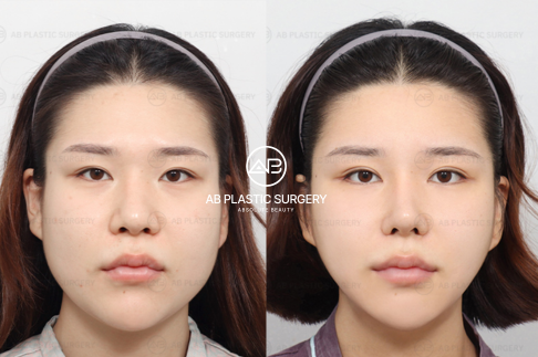 Why 87% of V-line Patients Choose Korea: Methods Only Available in Korea