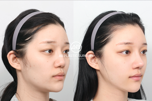 First-Timer's Guide: What to Expect When Getting Plastic Surgery in Seoul
