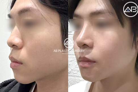 Upturned Nose: A Charming Feature or a Shape That Needs Correction?