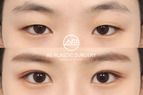 Double Eyelid Surgery in Korea: How to Choose the Right Method and Clinic as an International Patient