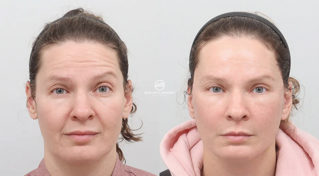 Deep Plane Facelift Korea: Structural Rejuvenation, Longevity, and Institutional Safety Standards