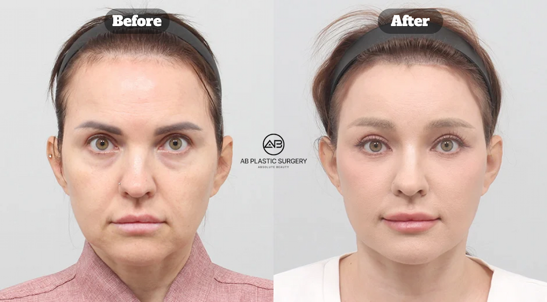 Facelift Surgery in Korea: Minimal Scars, Maximum Lift with the AB Plastic Surgery Method