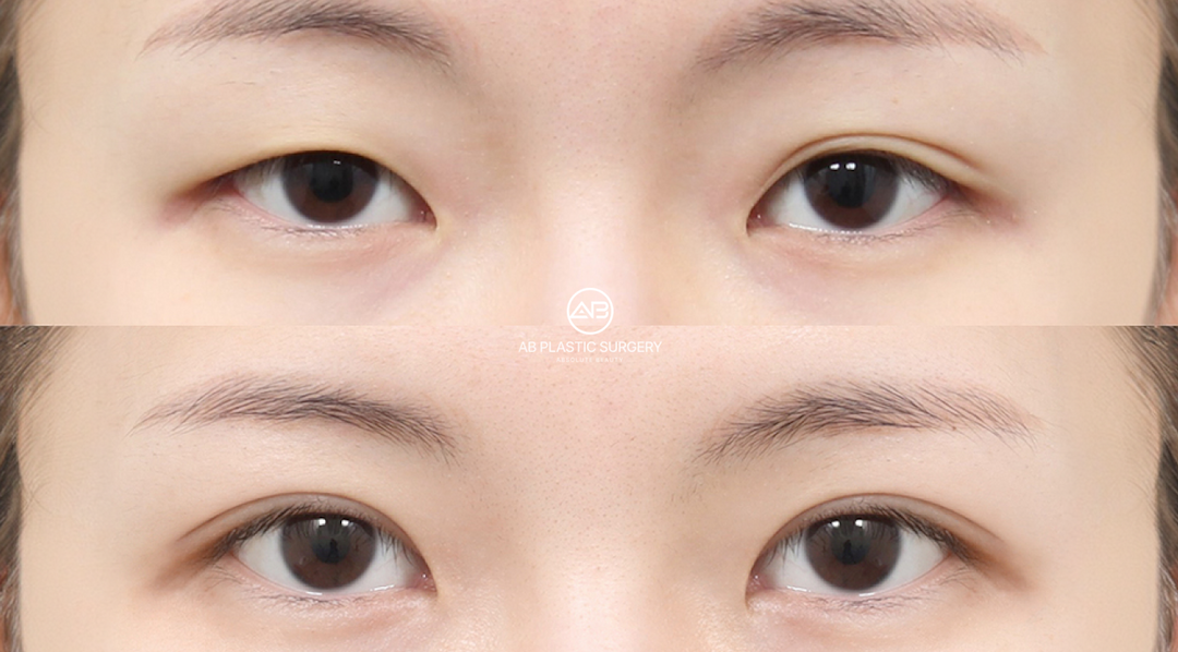 Korean Eyes vs Angel Eyes Surgery: What International Patients Should Know