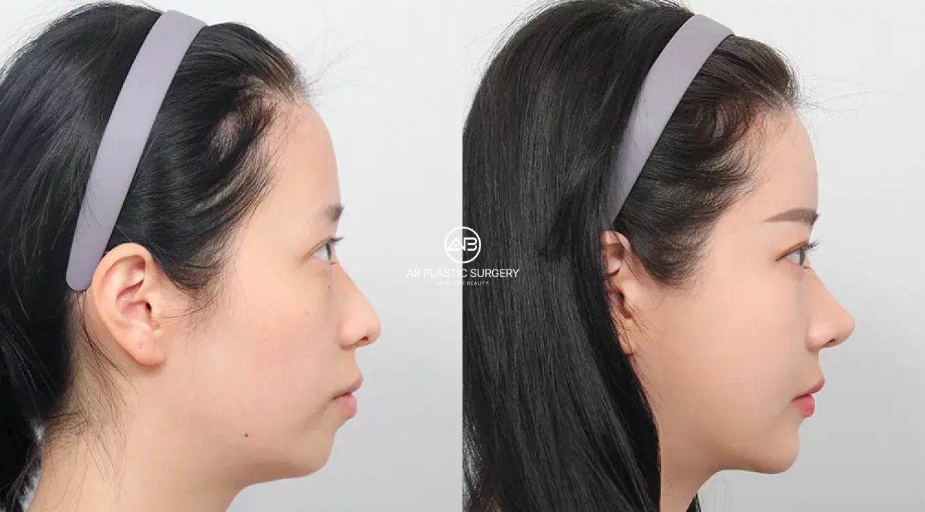 What Is Fat Grafting? A Complete Guide to Natural Volume Restoration