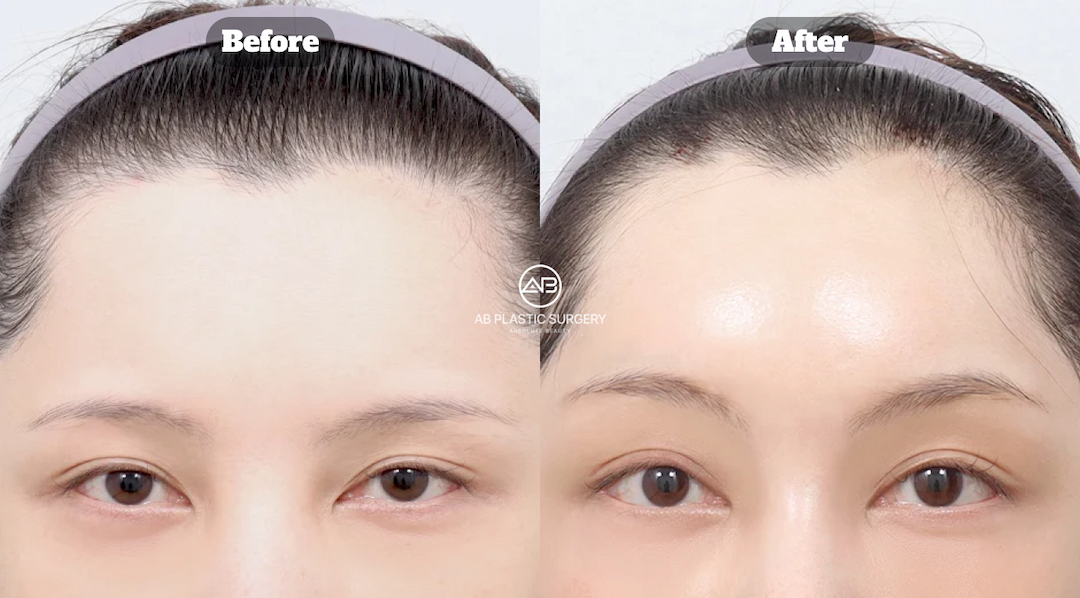 Endotine Brow Lift vs Botox Brow Lift: What's the Difference?