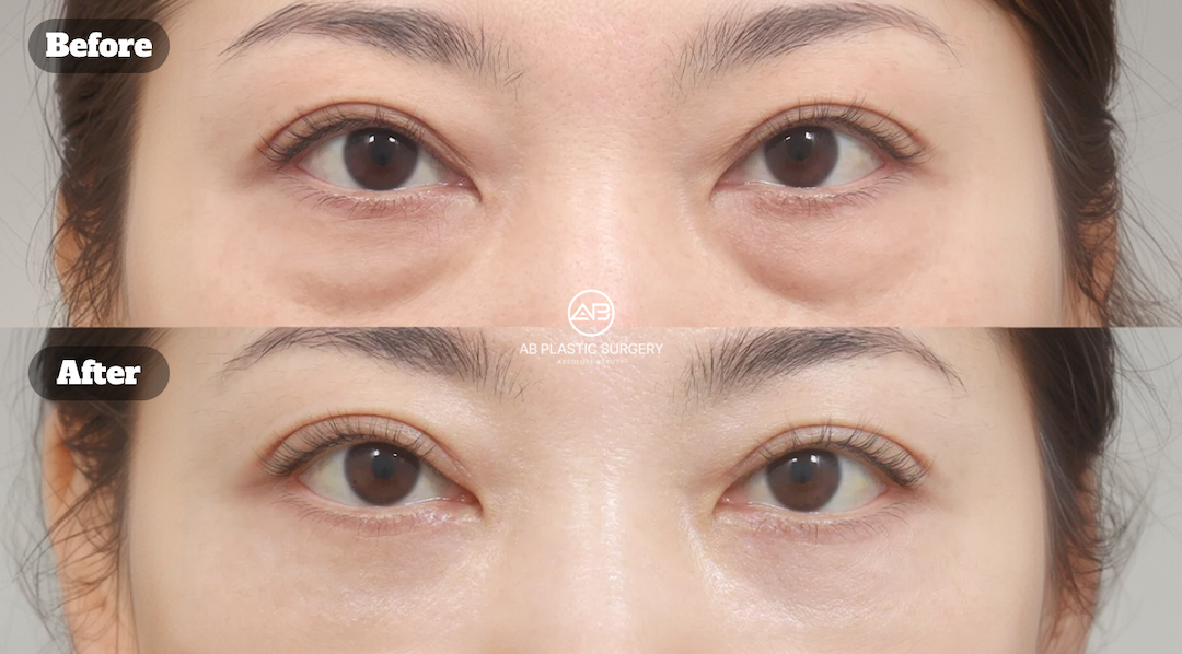 Tired Eyes Making You Look Older? Lower Blepharoplasty in Korea