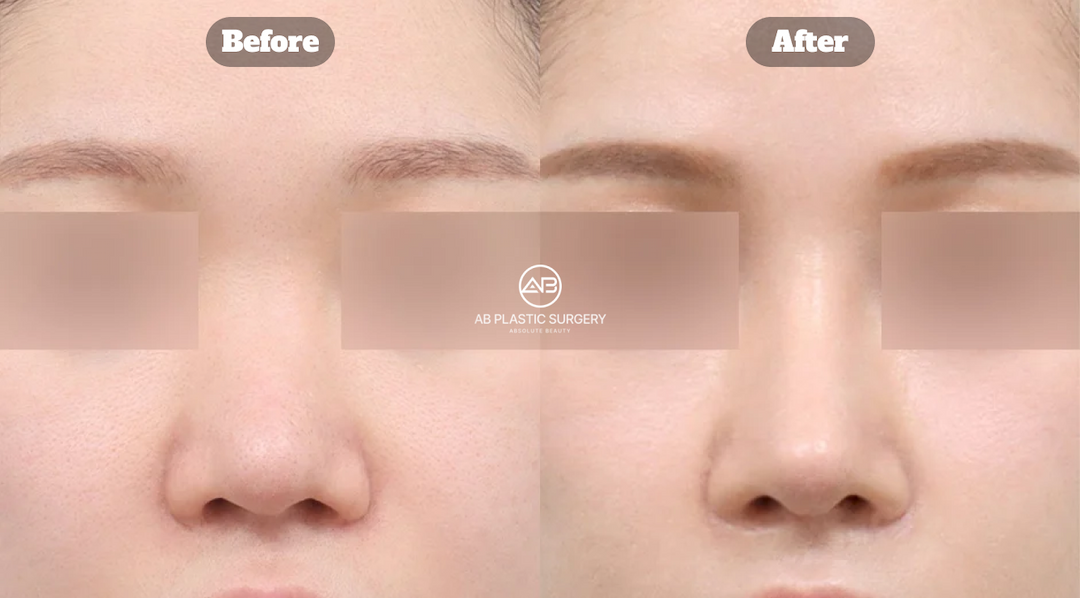Unsatisfied with Your Nose Surgery? Revision Rhinoplasty Guide in Korea