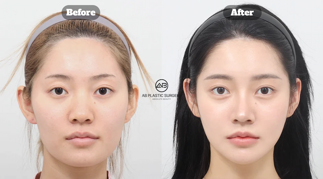 Genioplasty (Chin Tip Surgery) Explained, from Methods to Cost