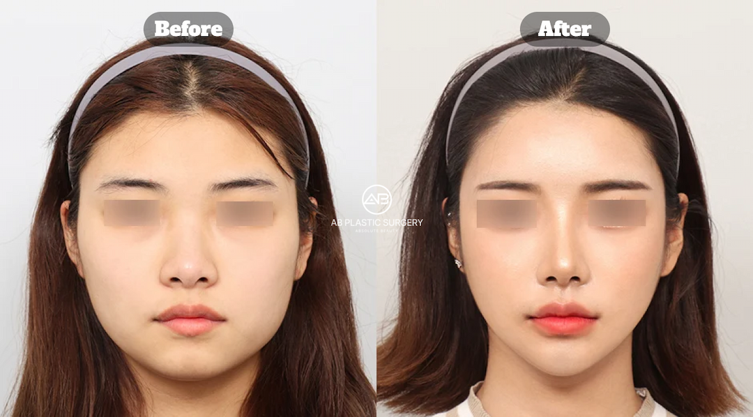 Under-Eye Fat Repositioning vs. Fat Removal: Which Is Better?