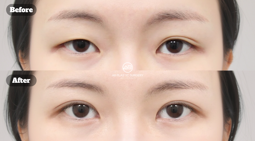 Revision Double Eyelid Surgery: Timing, What Gets Corrected, and What to Expect