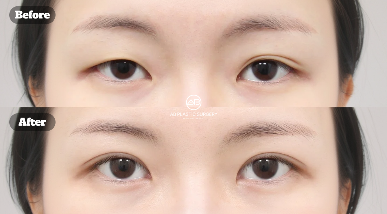 Revision Double Eyelid Surgery: Timing, What Gets Corrected, and What to Expect
