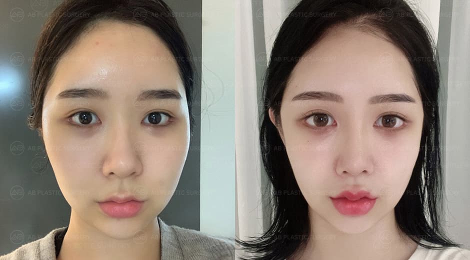 I was worried about sagging skin after contouring surgery, but I didn't experience any skin sagging at all.