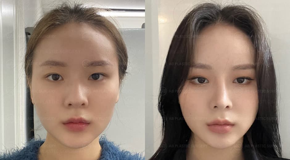 I am so happy with the beautiful cosmetic surgery that fits well with my facial proportions.