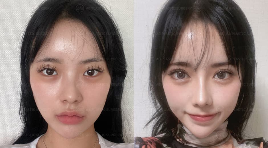 I was worried about the revision surgery for my eyes, but I'm satisfied with the elegant outcome.