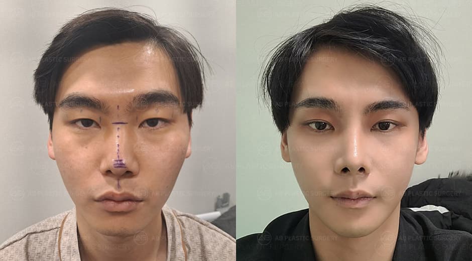 It's definitely a much more defined face compared to pre-surgery.