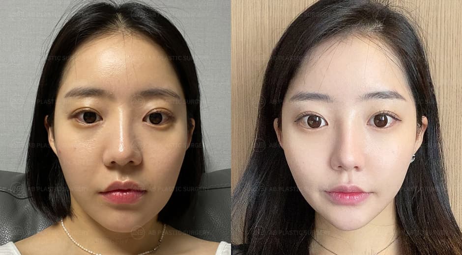 Square jaw surgery, frontal chin surgery, and reduction of prominent cheekbones.