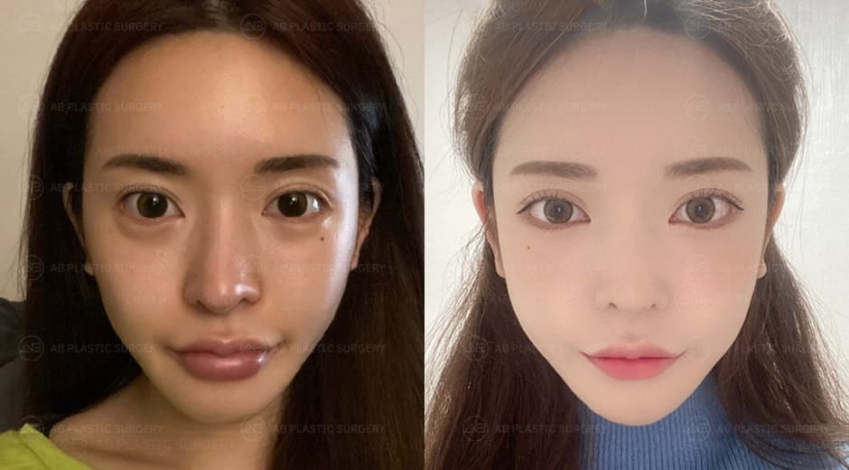 'Rhinoplasty Revision' done! My friend also got it done here after she saw my nose XD