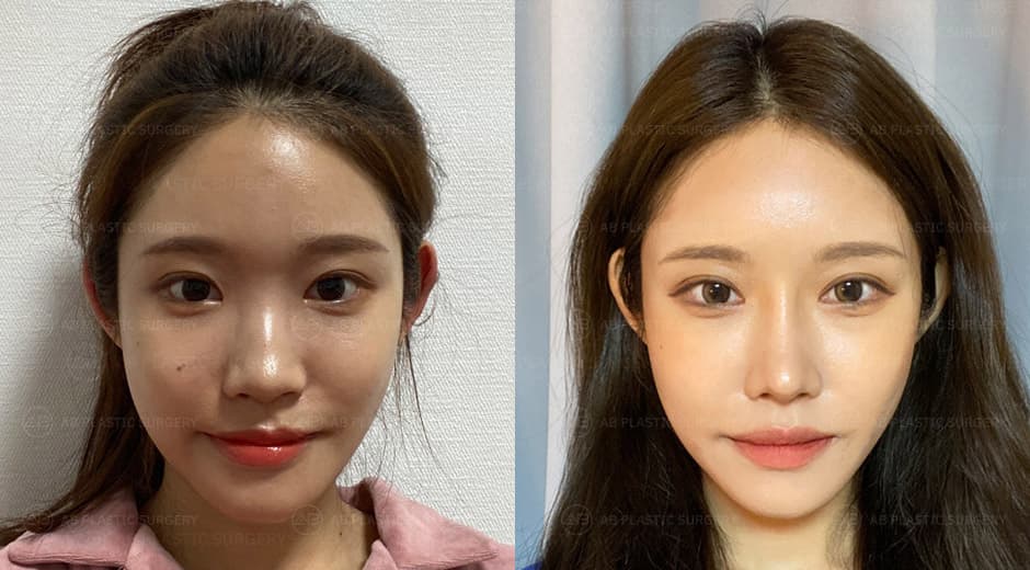 I keep hearing compliments about my eyes and nose even after 1 year since surgery! <Rhinoplasty, Non-Incision Double Eyelid Revision, Epicanthoplasty Revision>